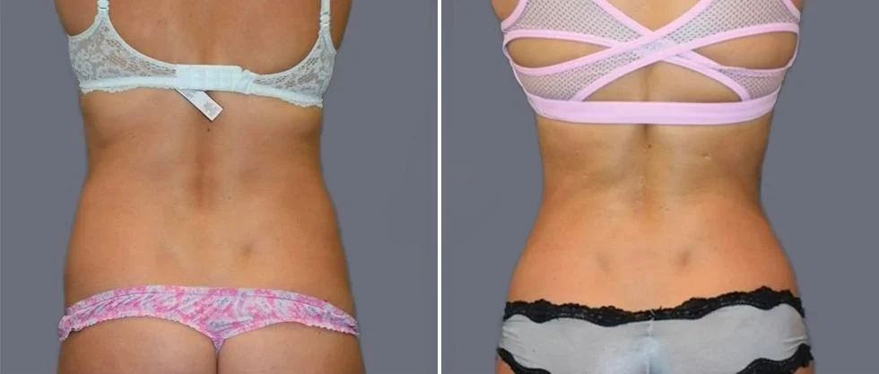 vaser back liposcution female pre2024 016 before and after before and after