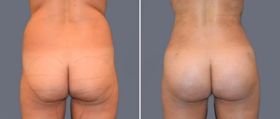 vaser back liposcution female pre2024 017 before and after before and after