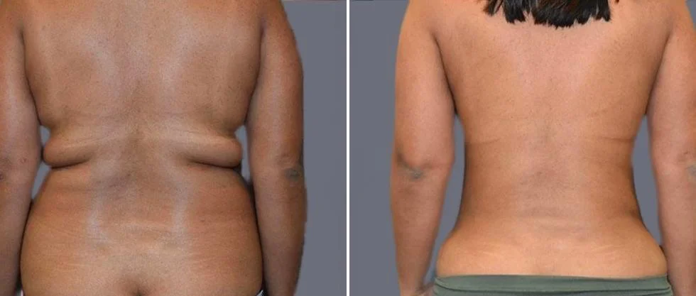 vaser back liposcution female pre2024 018 before and after before and after