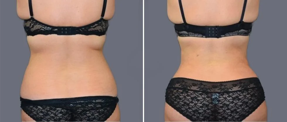 vaser back liposcution female pre2024 019 before and after before and after