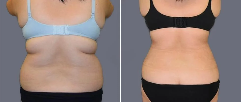 vaser back liposcution female pre2024 020 before and after before and after