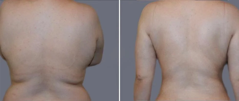 vaser back liposcution female pre2024 021 before and after before and after