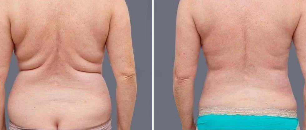vaser back liposcution female pre2024 022 before and after before and after
