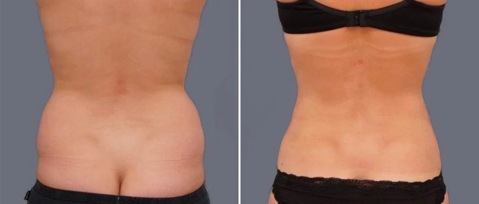 vaser back liposcution female pre2024 023 before and after before and after