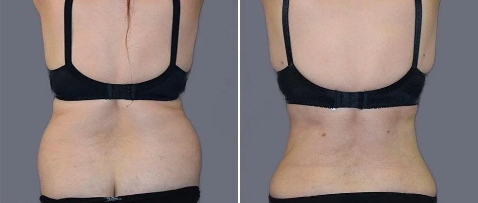 vaser back liposcution female pre2024 025 before and after before and after