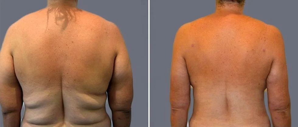 vaser back liposcution female pre2024 027 before and after before and after
