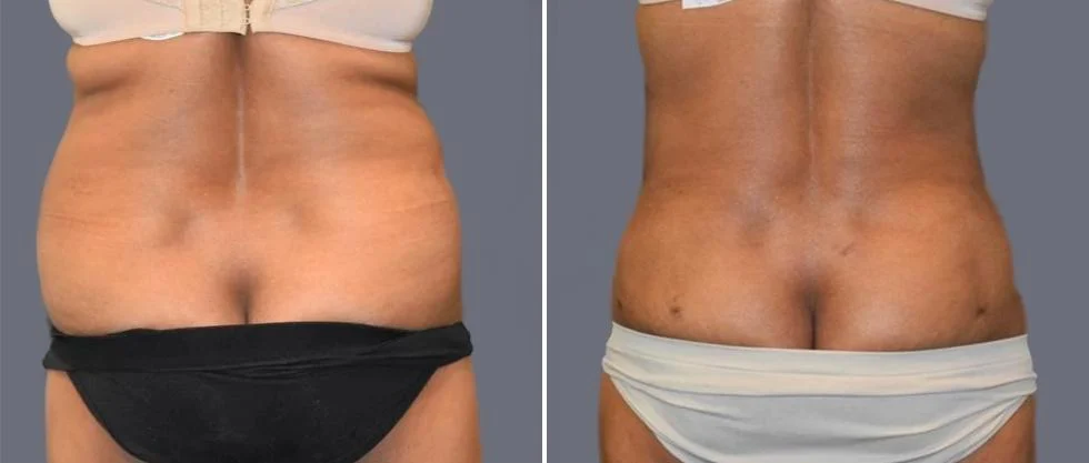 vaser back liposcution female pre2024 029 before and after before and after