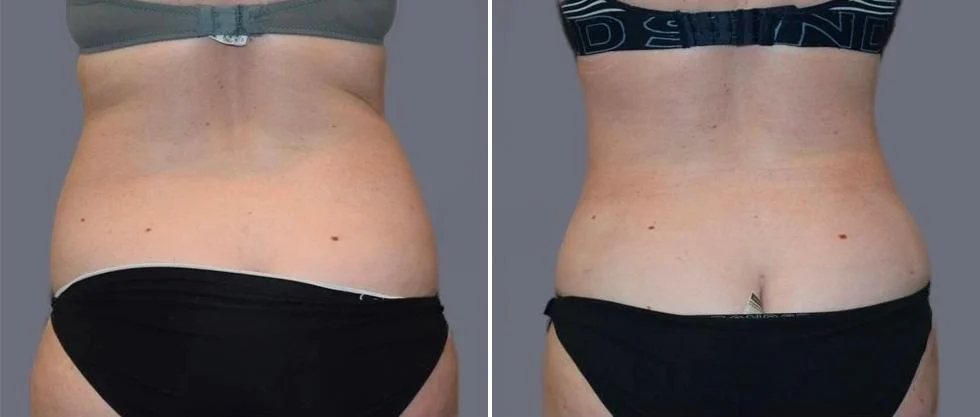 vaser back liposcution female pre2024 031 before and after before and after