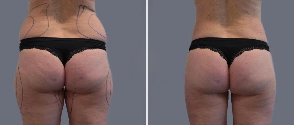 vaser back liposcution female pre2024 032 before and after before and after