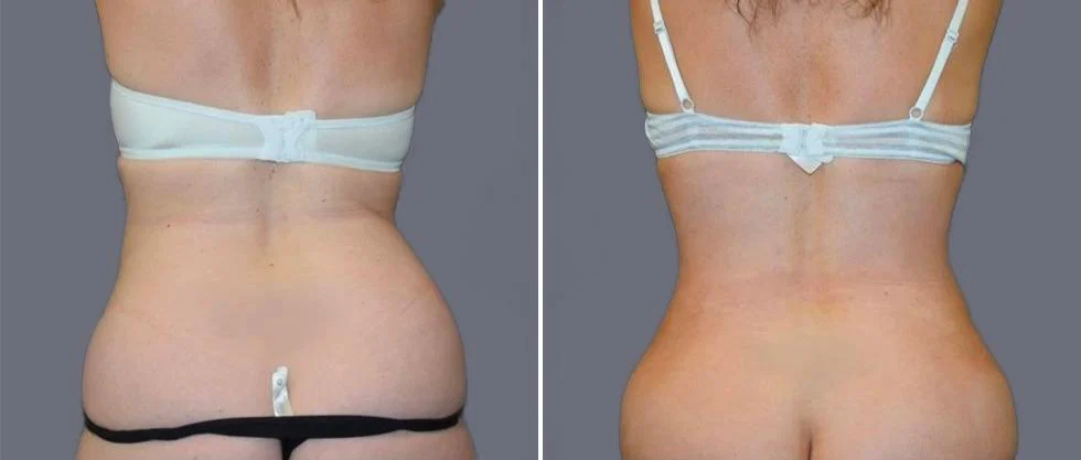 vaser back liposcution female pre2024 033 before and after before and after