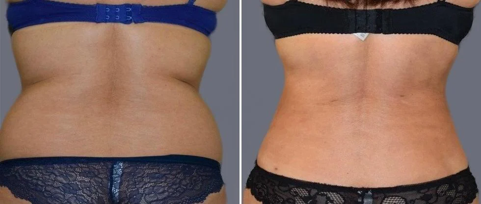 vaser back liposcution female pre2024 034 before and after before and after