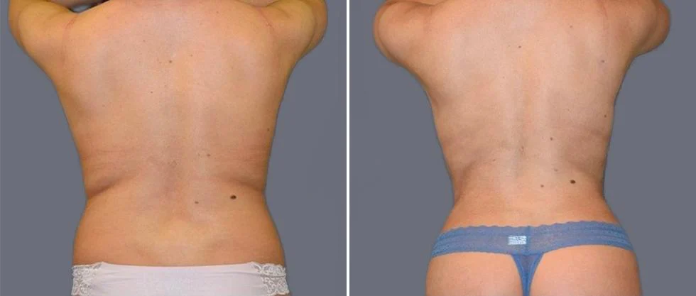 vaser back liposcution female pre2024 035 before and after before and after