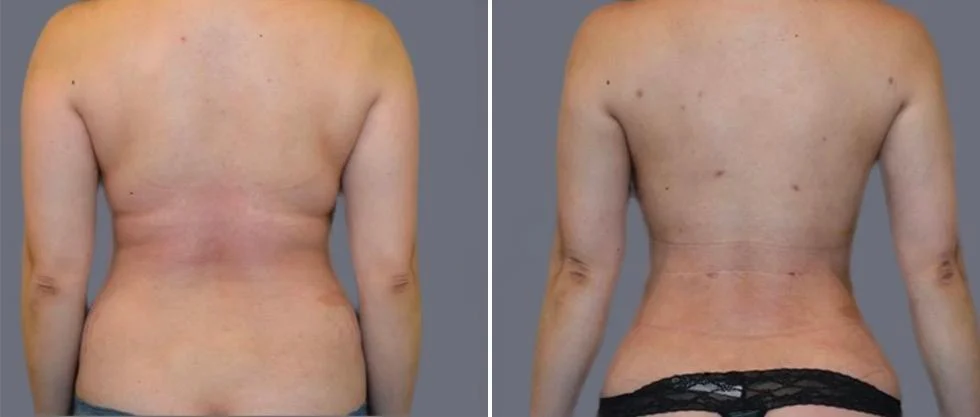 vaser back liposcution female pre2024 036 before and after before and after
