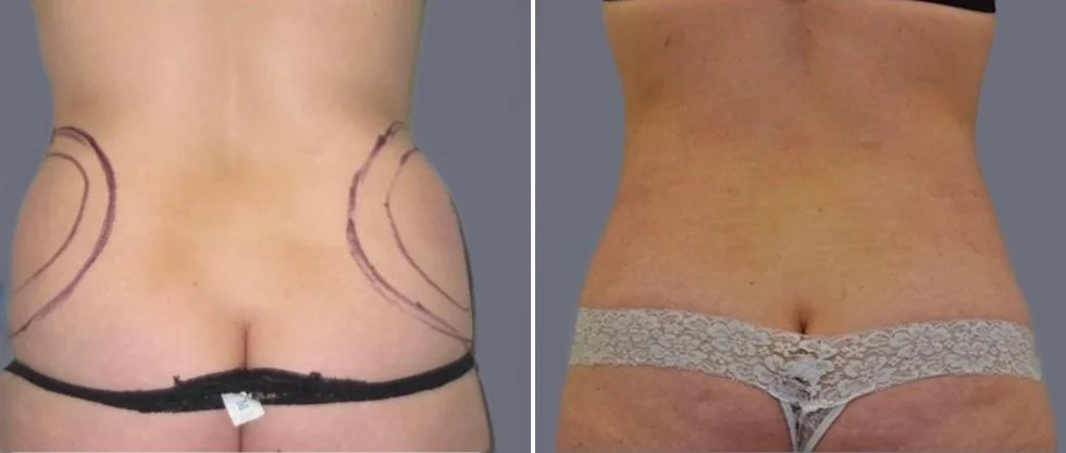 vaser back liposcution female pre2024 038 before and after before and after