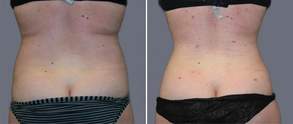 vaser back liposcution female pre2024 039 before and after before and after