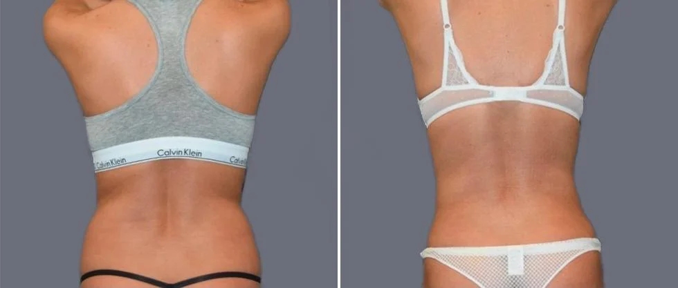 vaser back liposcution female pre2024 042 before and after before and after