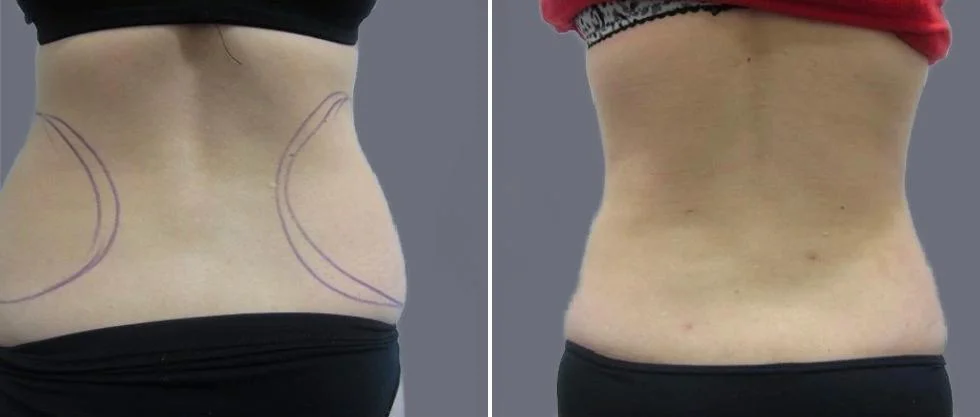 vaser back liposcution female pre2024 043 before and after before and after