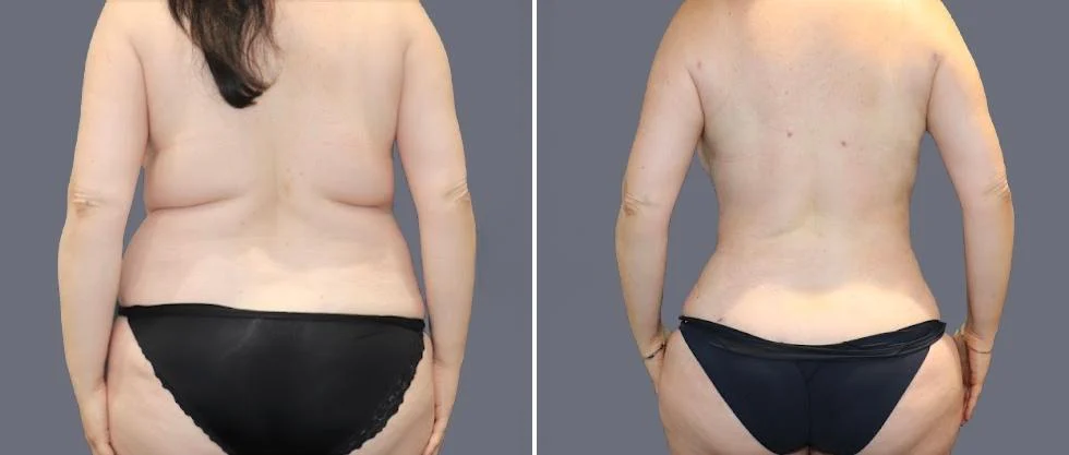 vaser back liposcution female pre2024 045 before and after before and after