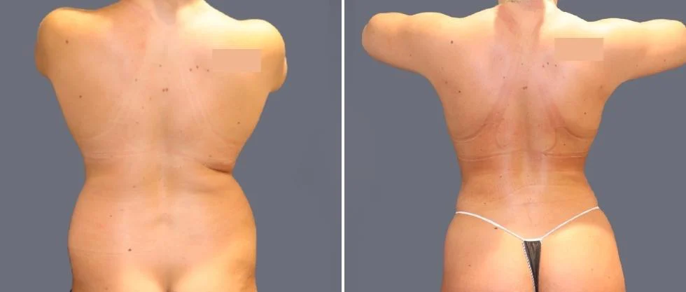 vaser back liposcution female pre2024 046 before and after before and after