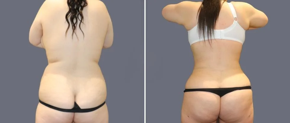 vaser back liposcution female pre2024 047 before and after before and after