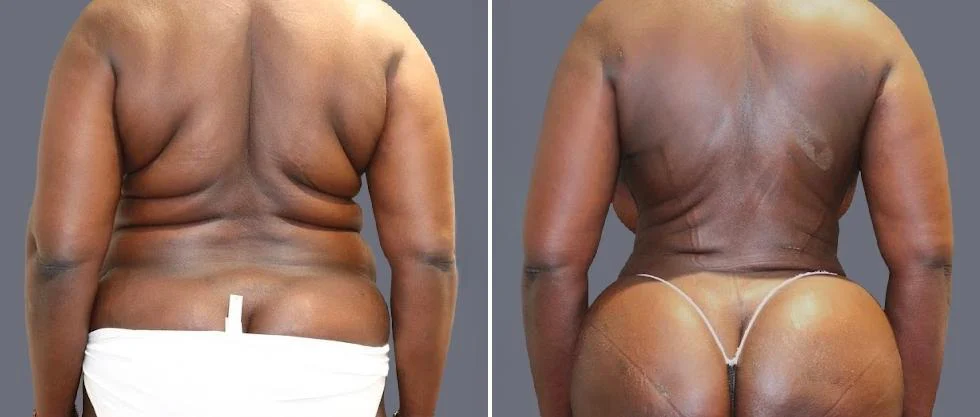 vaser back liposcution female pre2024 049 before and after before and after