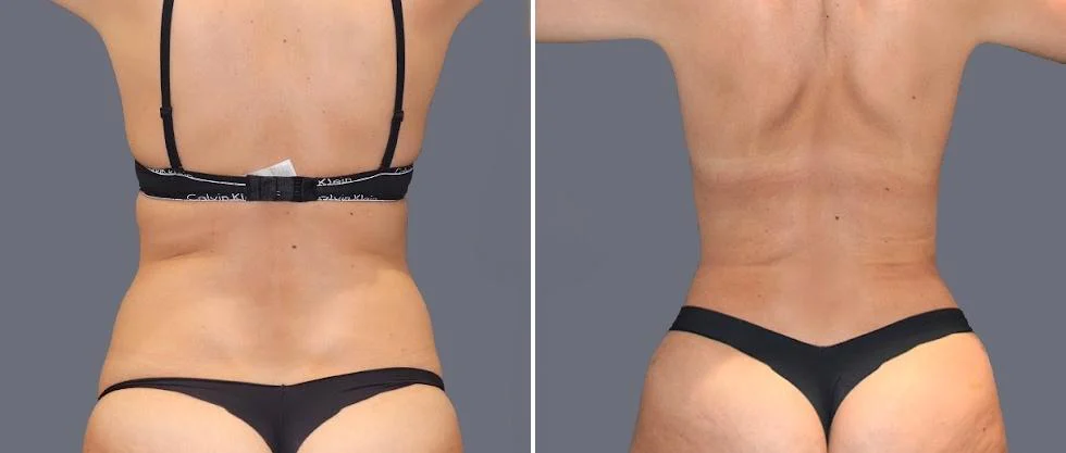 vaser back liposcution female pre2024 052 before and after before and after