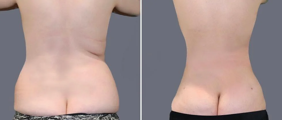 vaser back liposcution female pre2024 053 before and after before and after