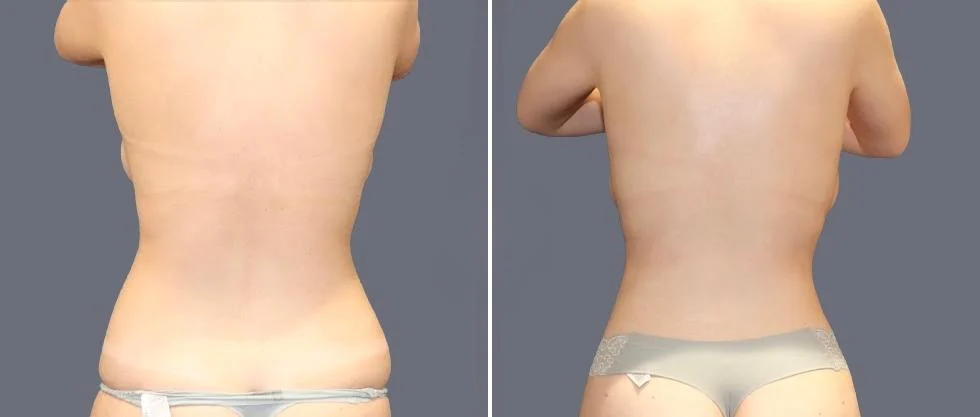 vaser back liposcution female pre2024 054 before and after before and after