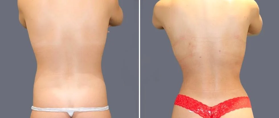 vaser back liposcution female pre2024 055 before and after before and after