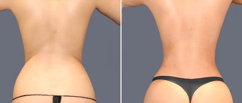 vaser back liposcution female pre2024 056 before and after before and after
