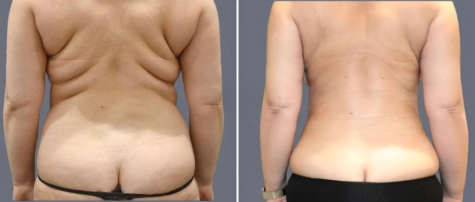 vaser back liposcution female pre2024 057 before and after before and after