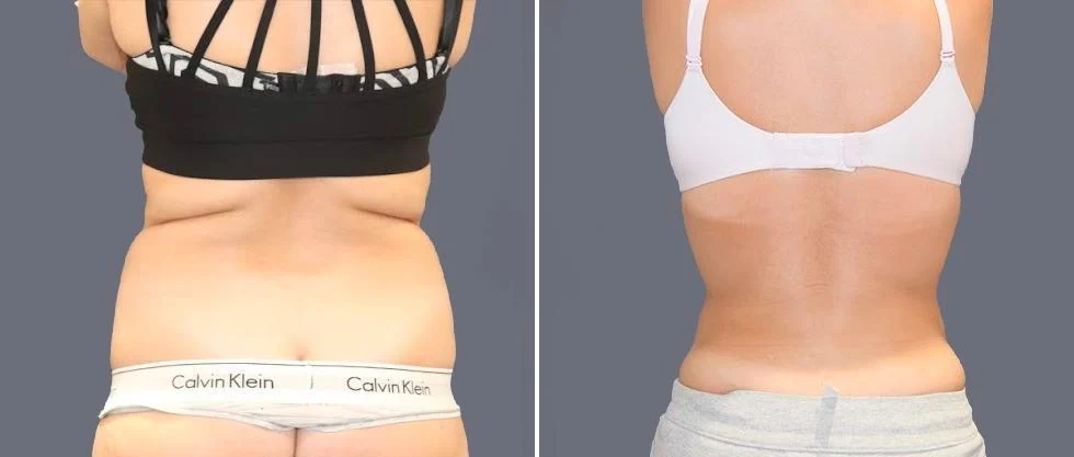 vaser back liposcution female pre2024 059 before and after before and after