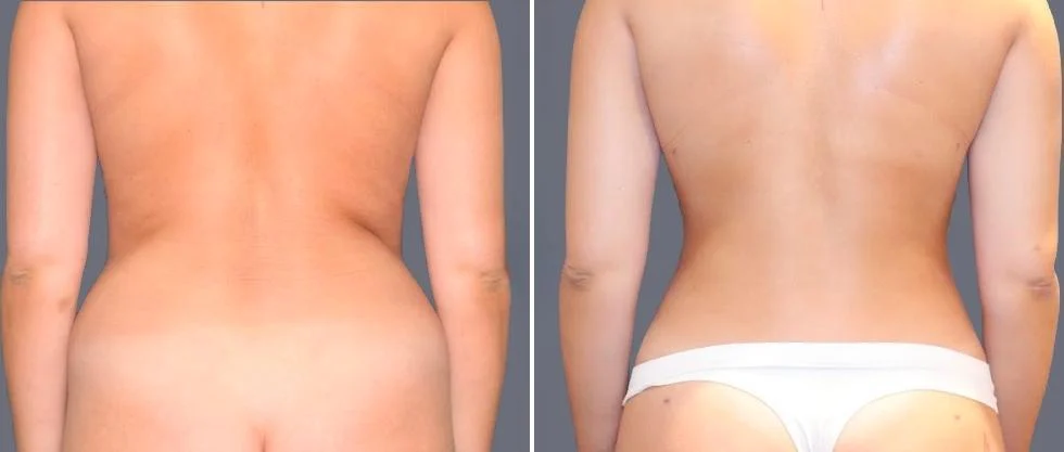 vaser back liposcution female pre2024 060 before and after before and after