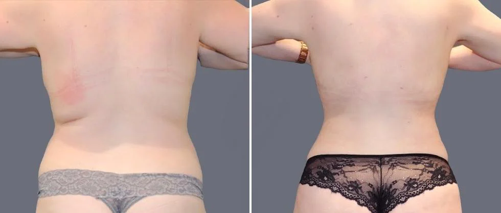 vaser back liposcution female pre2024 061 before and after before and after