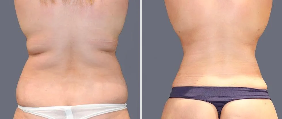 vaser back liposcution female pre2024 062 before and after before and after