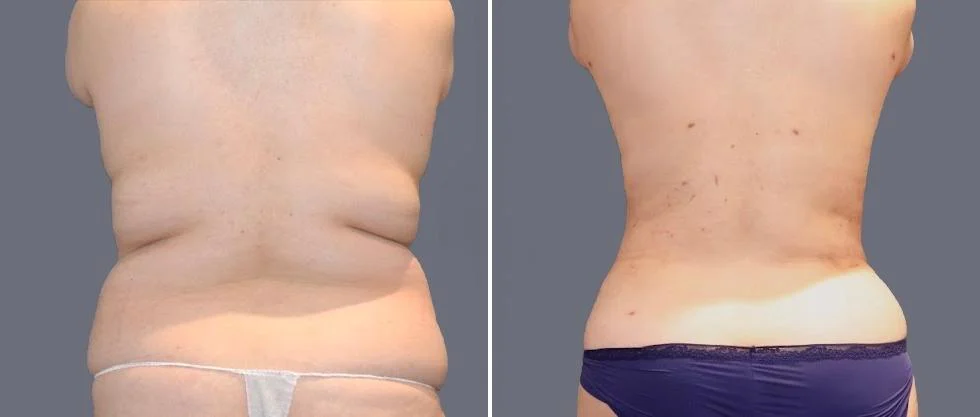 vaser back liposcution female pre2024 063 before and after before and after
