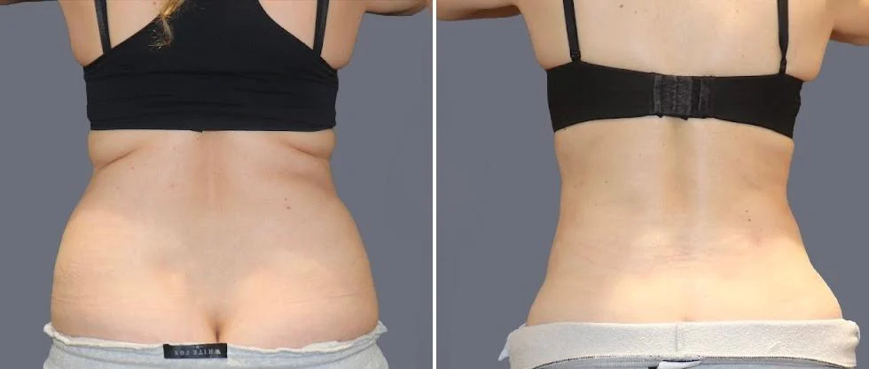 vaser back liposcution female pre2024 064 before and after before and after