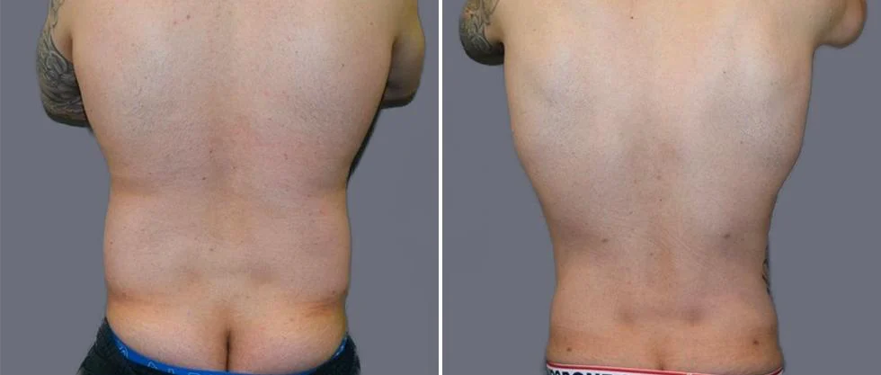 vaser back liposcution male pre2024 001 before and after before and after