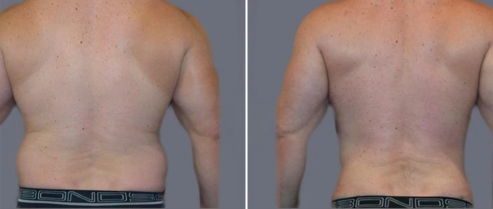 vaser back liposcution male pre2024 002 before and after before and after