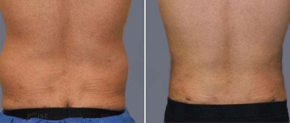 vaser back liposcution male pre2024 003 before and after before and after