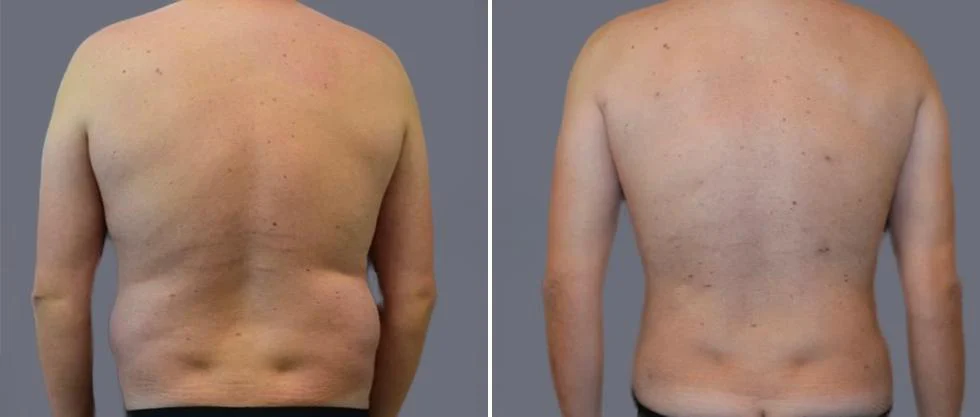 vaser back liposcution male pre2024 004 before and after before and after