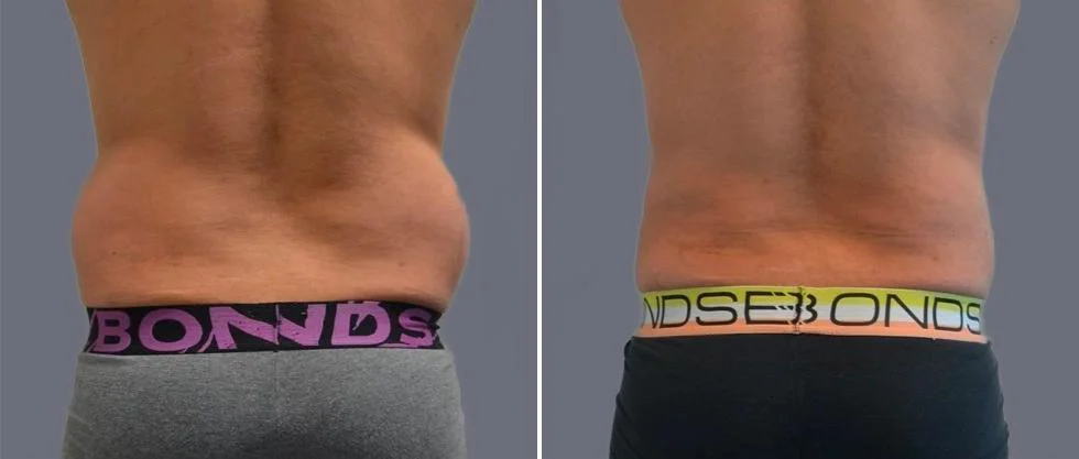 vaser back liposcution male pre2024 007 before and after before and after