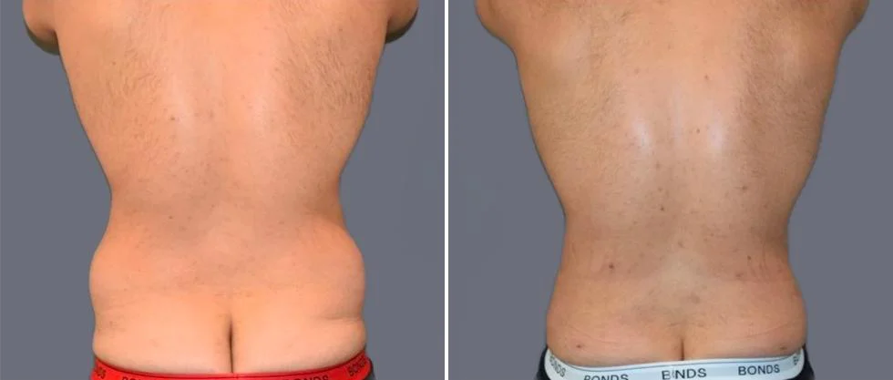 vaser back liposcution male pre2024 008 before and after before and after