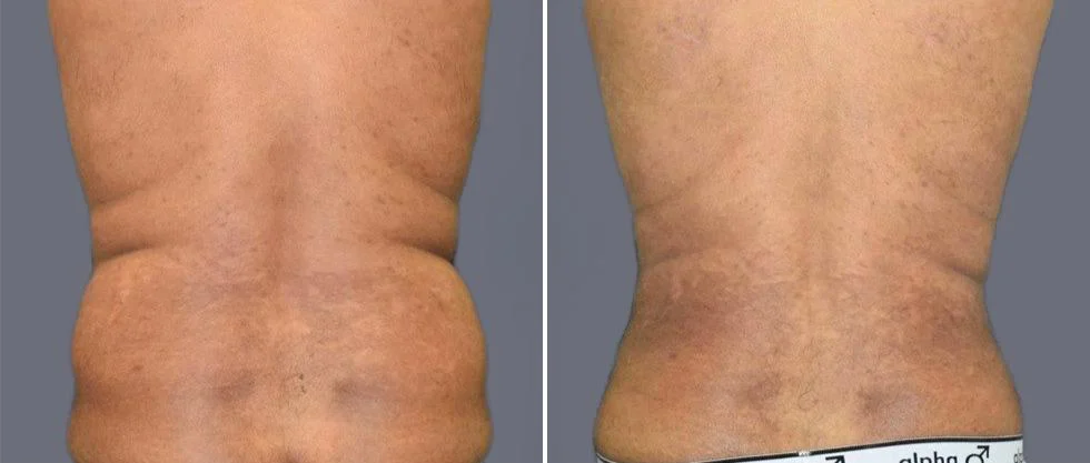 vaser back liposcution male pre2024 010 before and after before and after