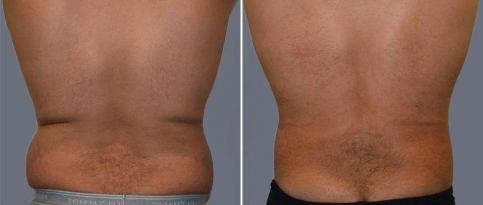 vaser back liposcution male pre2024 011 before and after before and after