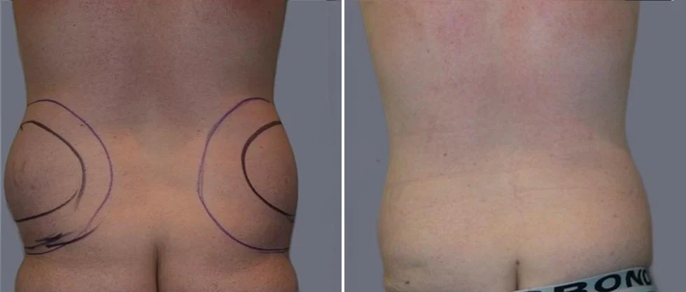 vaser back liposcution male pre2024 012 before and after before and after