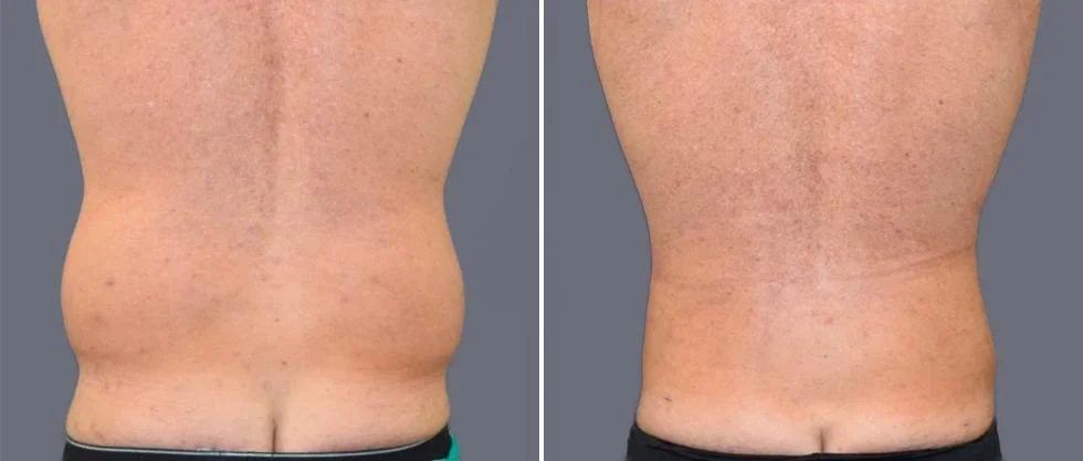 vaser back liposcution male pre2024 013 before and after before and after