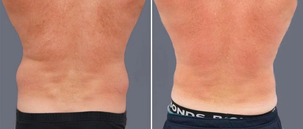 vaser back liposcution male pre2024 014 before and after before and after
