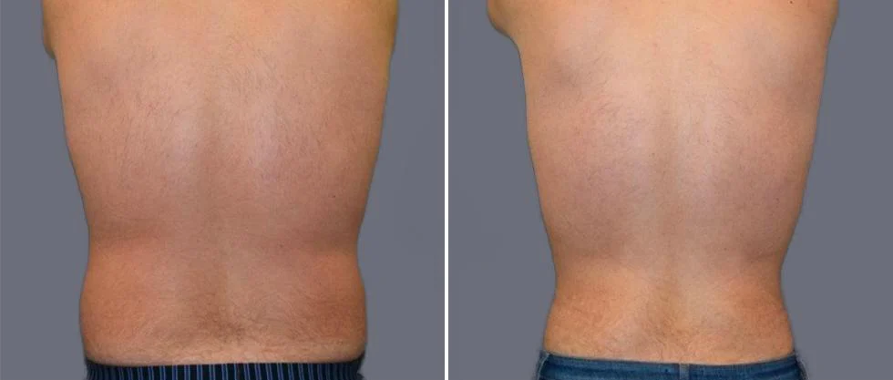 vaser back liposcution male pre2024 015 before and after before and after