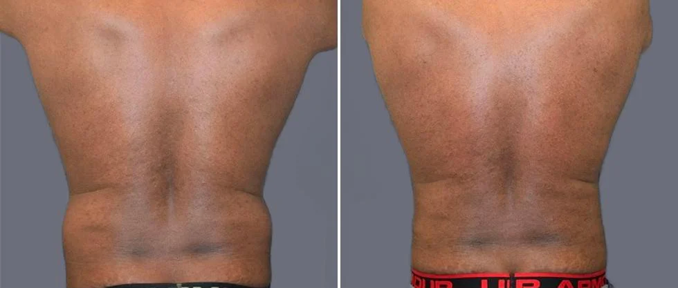vaser back liposcution male pre2024 016 before and after before and after